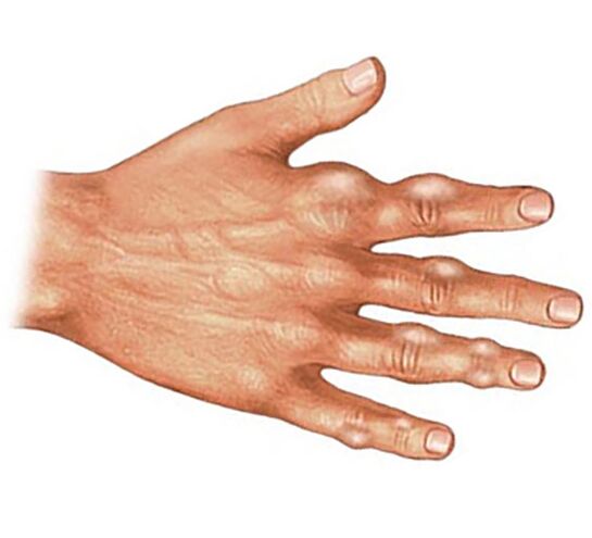 Deposition of uric acid crystals in the soft tissues of the fingers with gouty arthritis