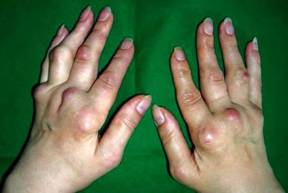 Hands affected by polyosteoarthritis deformities