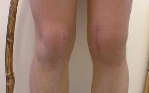 stages of development of knee osteoarthritis