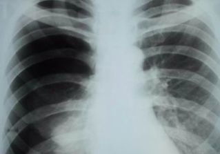 treatment of pulmonary
